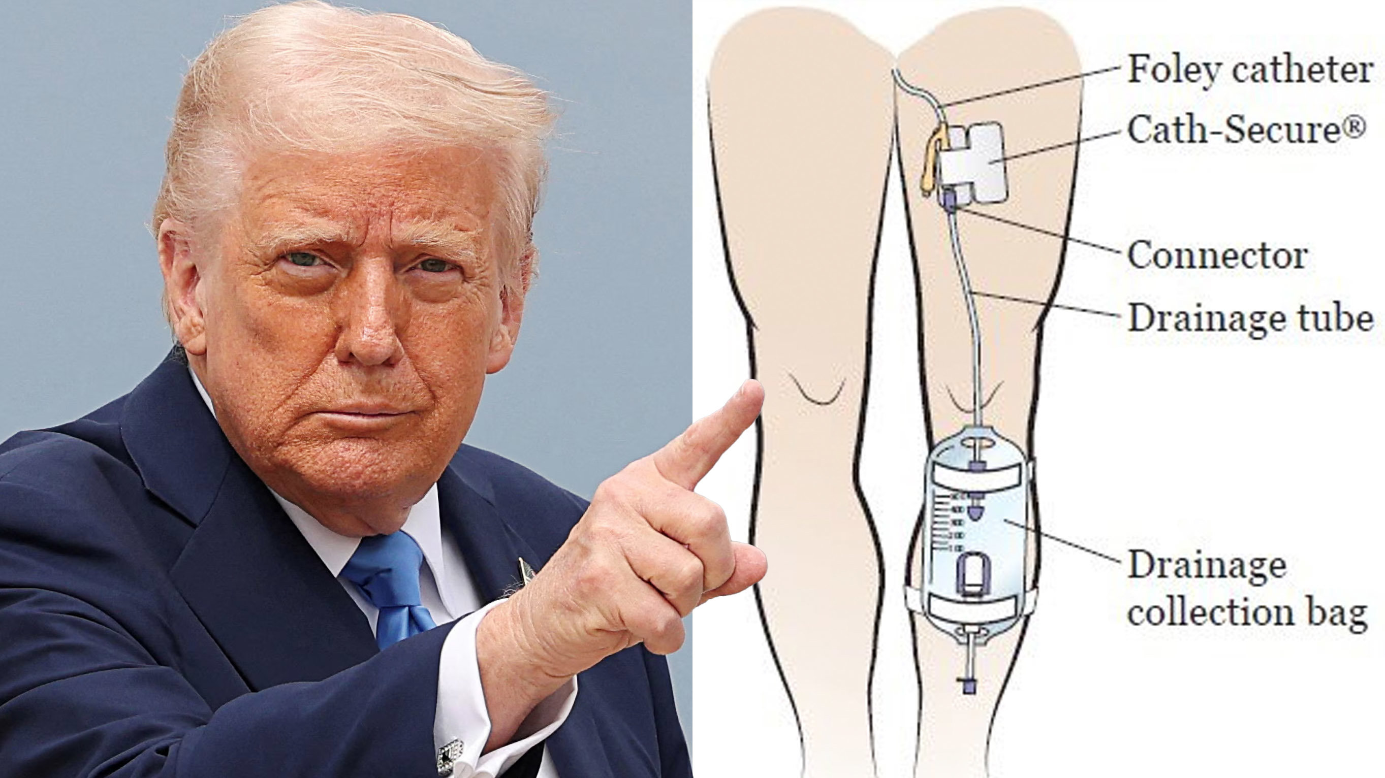 Trump-catheter-theory