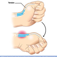 How to Break Your Thumb Ligament
