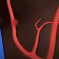 Brain Fart / Aneurysm Animation Brain Fart Aneurysm Animation meme from youtube depicting a blood vessel bursting in someone's head.