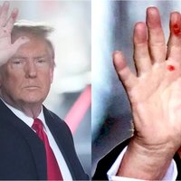 A photo of donald trump with blistered hands.