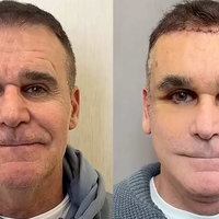 Dr. Kim Plastic Surgeon TikTok depicting an example before and after image.