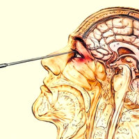 Lobotomy meme slang term meaning.