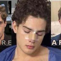Clavicular Nose Job image examples.