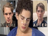 Clavicular Nose Job image examples.