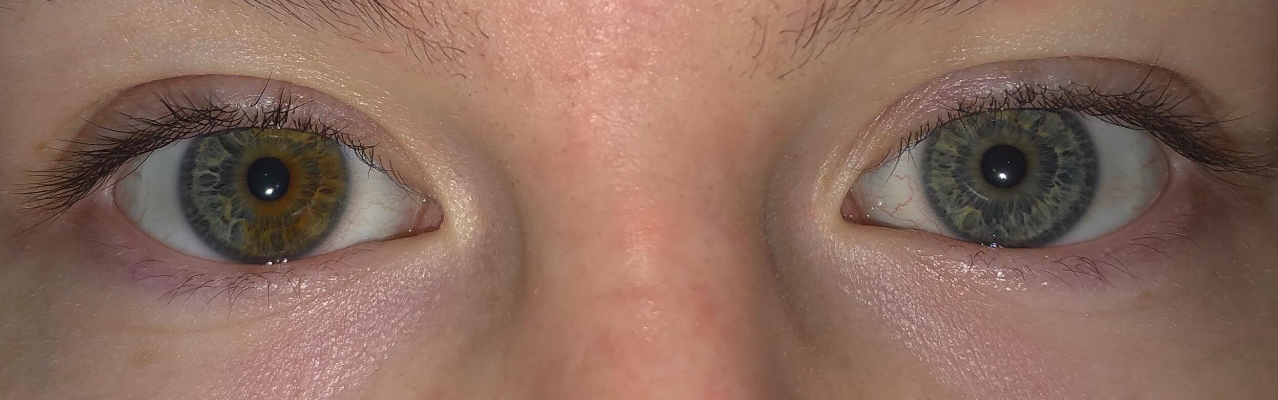 I have heterochromia. My right eye is half brown, half blue, and my