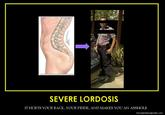 SEVERE LORDOSIS IT HURTS YOUR BACK, YOUR PRIDE, AND MAKES YOU AN A------ funnydemotionalposters.com