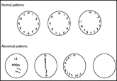 Nomal patterns: 12 3 Abnomal pattems: DOO 12 NOON 3. 2. 6o