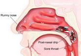 U/penisimaoo Runny nose Post-nasal drip Sore throat-