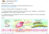 Jesse Morse, MD @DrJesseMorse Damar Hamlin Suffered a cardiac arrest likely due to #commotiocordis. Some important things to note: 1. Commotio cordis occurs when an object, usually a baseball, hits the chest well. 2. This has to happen at an exact spot in the cardiac cycle (T wave). (1/) External variables Impact object Circular shape Greater hardness Smaller diameter Velocity • Peak 40 mph Orientation • Direct Chest wall variables • Greater compliance • Thinner Location directly over heart Focal ventricular depolarization (20 ms window) 11:21 AM Jan 3, 2023 Time Rapid increase in intracavitary pressure Amplified dispersion of repolarization Activation of KATP lon channel • Increase K+ current across cell membrane VF . ? involvement of other ion channels www Cell membrane stretch навивантними Upstroke of T wave Moment of impact KATP channel : ... AAAU
