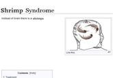 Shrimp Syndrome Instead of brain there is a shrimps 1 Treatment Contents [hide] Like this
