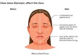 How does Ozempic affect the face Before MEDICAL NEWS TODAY After a hollowed-out appearance increased signs of aging, such as more lines & wrinkles loss of fat, which can lead the skin to become loose & sag