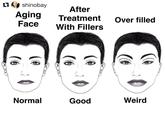 17 shinobay Aging Face After Treatment With Fillers Over filled Normal Good Weird
