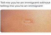 An image macro consisting of an image of a TB vaccine scar. The caption reads, "Tell me you're an immigrant without telling me you're an immigrant."