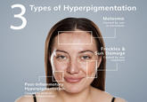 3 Types of Hyperpigmentation Melasma Caused by sun or hormones Post-Inflammatory Hyperpigmentation Caused by acne or rashes/inflammation Freckles & Sun Damage Caused by sun exposure