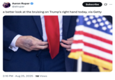 Aaron Rupar @atrupar Subscribe ... a better look at the bruising on Trump's right hand today, via Getty 2:16 PM - Aug 25, 2025 1M Views