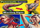 Pancreatic Cancer Warning Signs