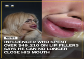 THINGS THINGS NEWS INFLUENCER WHO SPENT OVER $49,210 ON LIP FILLERS SAYS HE CAN NO LONGER CLOSE HIS MOUTH FACEBOOK.COM/THINGS YOUDONT KNOW OFFICIAL