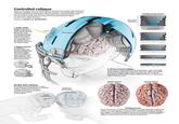 Controlled collapse Gone are the days when a football helmet consisted of a simple rigid shell lined with foam padding. Instead, new materials, designs, and technologies enable a modern helmet to flex and deform. Tests that mimic real head blows show the new features help absorb energy and limit potentially damaging accelerations within the brain. Graphic by NOELLE BURGESS 1 Softer shells Molded from more pliable materials and perforated to allow for flexing, the shell of a modern football helmet bends under a blow, much like a car's crumple zones do. Unlike the car, the helmet returns to its original shape. 2 Bigger helmets Continuing a decadeslong trend, modern helmets have also gotten bigger. The extra padded space between shell and scalp gives the head more room and time to slow down. 1970- 1990s 2020s Impact 1 Deformation Action and reaction As a player's head recoils from a blow. it can undergo straight linear acceleration, twisting rotational acceleration. or both, depending on the blow's direction and location on the helmet. Linear acceleration Rotational acceleration 3D-printed padding 3D-printed elastomer Padding during impact Collapsible segment Foam cushion 3 3D less-is-more padding Many modern helmets employ 3D-printed liners, such as the K3D technology from KOLLIDE. Such pads exploit the subtle and tunable physics of crumpling. Made of less material, they can compress to as little as 10% to 20% of their original thickness, as opposed to 40% to 50% for foam. Before impact During impact Twisting trauma Key to concussion, a rotational acceleration can cause the brain to twist and stretch-in some regions, as much as 20%, computer simulations like this one suggest. The stretching appears to set off a cascade of cellular signaling that causes concussion symptoms. Test protocols aim to probe a helmet's ability to reduce both linear and rotational accelerations.