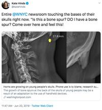 Kate Hinds @katehinds Entire @WNYC newsroom touching the bases of their skulls right now. "Is this a bone spur? DO I have a bone spur? Come over here and feel this! 27.8 mm Horns are growing on young people's skulls. Phone use is to blame, research su... The growth of bone spurs at the back of the skulls of young people may be a result of an adaptation to the use of handheld devices. washingtonpost.com 11:47 AM Jun 20, 2019 Twitter Web Client