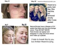 May 21 May 27 May 28 May 22 thestanconfessions/tumblr.com Heard at a party next day. She had this pic removed shortly after it was posted Natural Bruises have a lifespan of 2-4 weeks they fade over time and change colors. They DO NOT MOVE! Fake bruises can appear and disappear in a day and move where ever make up is placed. I hate to break this to you but Amber Heard is lying.