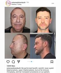 estemedistanbultr 10h Istanbul, Turkey 8 Q V ☑ a 7,004 likes ☑ estemedistanbultr We performed facelift, necklift, lower eyelid blepharoplasty, upper blepharoplasty, buccal fat removal, rhinoplasty, and hair transplant procedures on our patient,