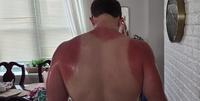 The sunscreen expired