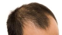 TIL that male pattern baldness doesn’t typically affect Native American, First Nations and Alaska Na...