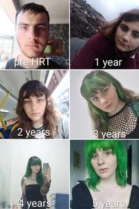 pre-HRT ast EXI 1 year 2 years 3 years 4 years 5 years