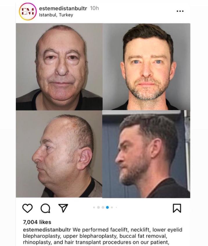 estemedistanbultr 10h Istanbul, Turkey 8 Q V ☑ a 7,004 likes ☑ estemedistanbultr We performed facelift, necklift, lower eyelid blepharoplasty, upper blepharoplasty, buccal fat removal, rhinoplasty, and hair transplant procedures on our patient,