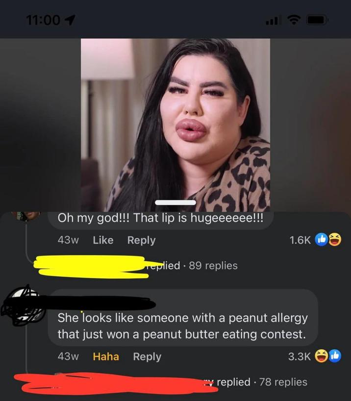 11:001 Oh my god!!! That lip is hugeeeeee!!! 43w Like Reply replied 89 replies L 1.6K She looks like someone with a peanut allergy that just won a peanut butter eating contest. 43w Haha Reply 3.3K replied 78 replies
