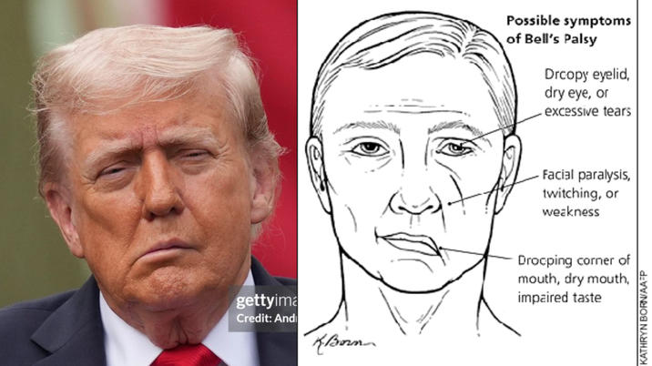 Possible symptoms of Bell's Palsy Drcopy eyelid, dry eye, or excessive tears Facial paralysis, twitching, or weakness gettyima Credit: And KBorn Drocping corner of mouth, dry mouth, impaired taste KATHRYN BORN/AA-P