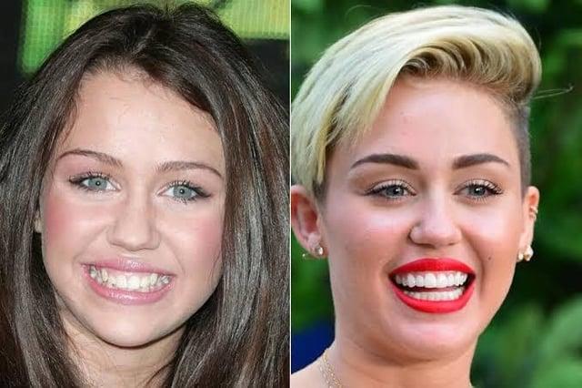 Thoughts on veneers?