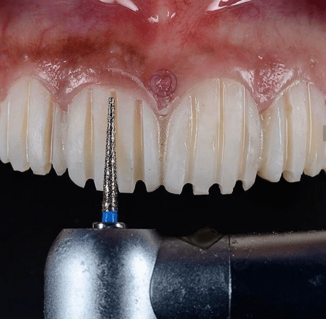Veneers Preparation