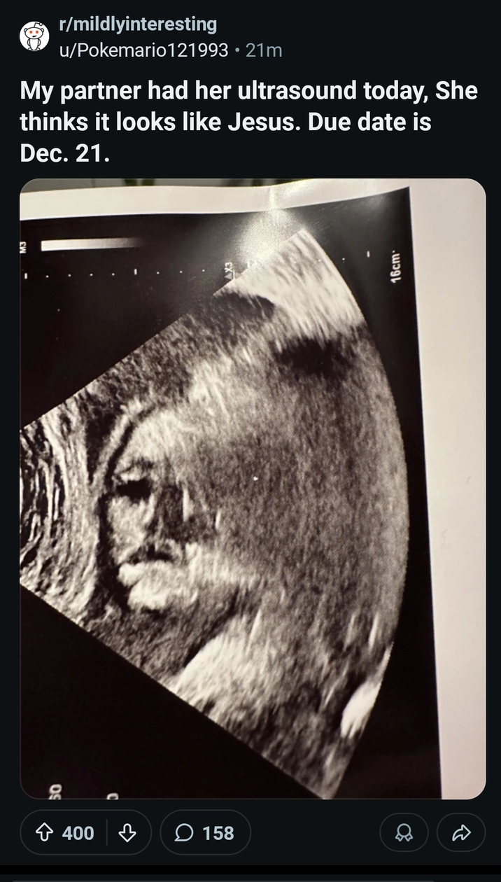 50 400 158 r/mildlyinteresting u/Pokemario121993 • 21m My partner had her ultrasound today, She thinks it looks like Jesus. Due date is Dec. 21. 16cm