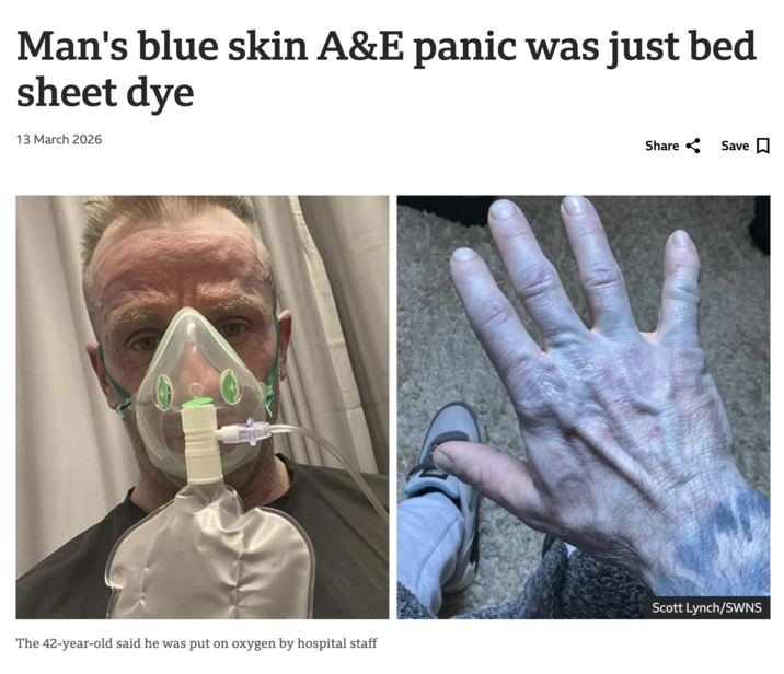 Man's blue skin A&E panic was just bed sheet dye 13 March 2026 Share Save ☐ Scott Lynch/SWNS The 42-year-old said he was put on oxygen by hospital staff