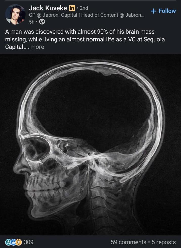 . Jack Kuveke in ⚫ 2nd GP @ Jabroni Capital | Head of Content @ Jabron... 5h⚫ + Follow A man was discovered with almost 90% of his brain mass missing, while living an almost normal life as a VC at Sequoia Capital.... more 309 59 comments • 5 reposts