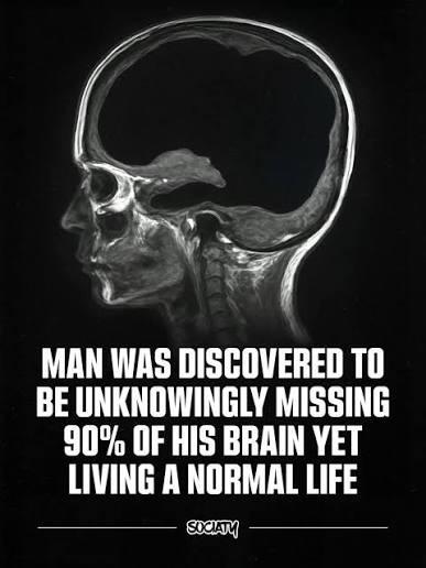 MAN WAS DISCOVERED TO BE UNKNOWINGLY MISSING 90% OF HIS BRAIN YET LIVING A NORMAL LIFE SOCIATY