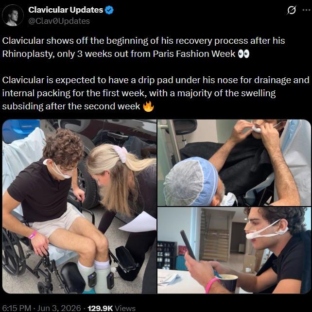 Clavicular Updates @Clav0Updates Clavicular shows off the beginning of his recovery process after his Rhinoplasty, only 3 weeks out from Paris Fashion Week 0 Clavicular is expected to have a drip pad under his nose for drainage and internal packing for the first week, with a majority of the swelling subsiding after the second week 6:15 PM - Jun 3, 2026 129.9K Views