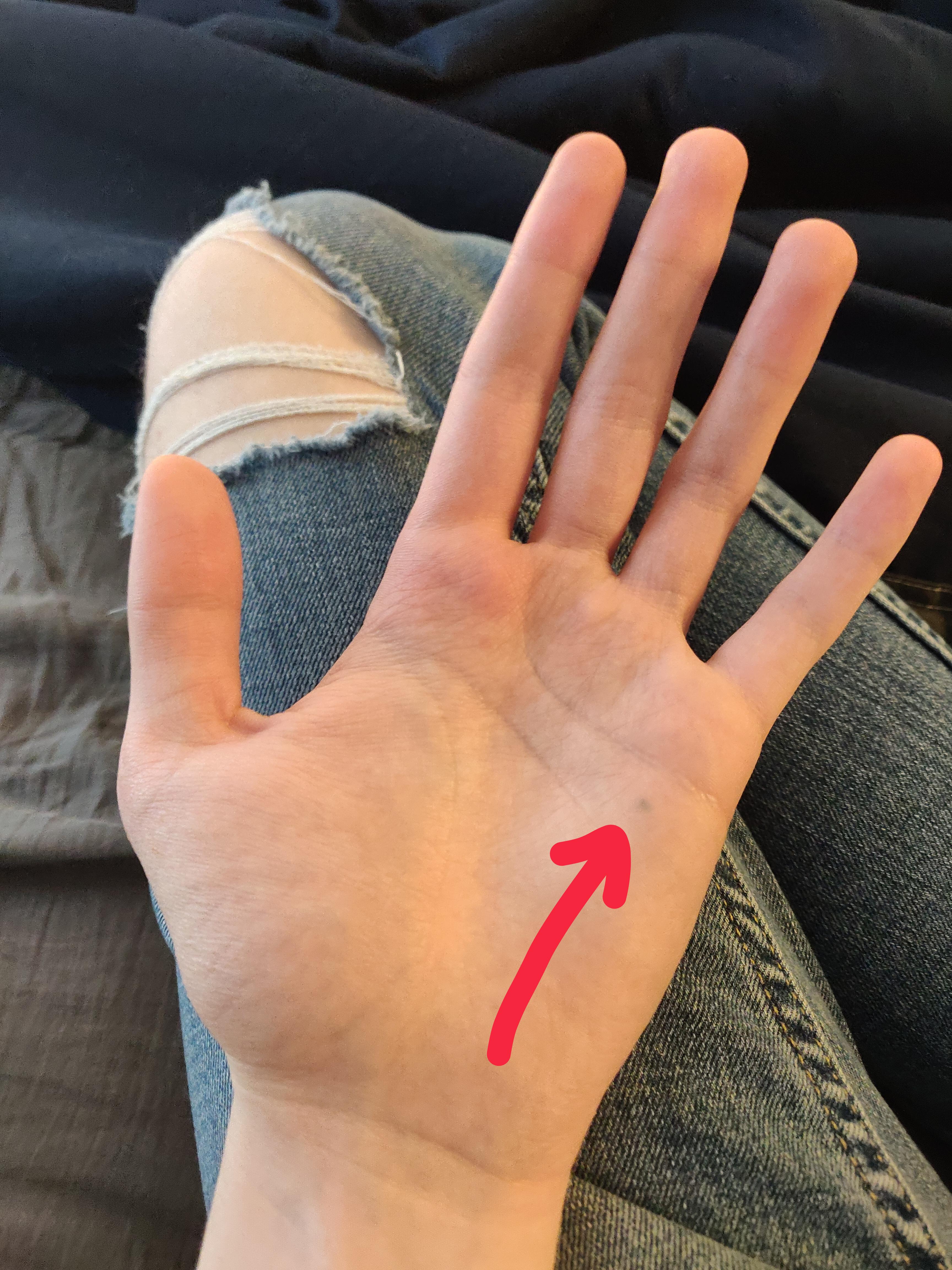 About 10 Years Ago I Got A Piece Of Pencil Lead Stuck In My Hand 10 