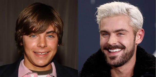Zach Efron Veneers