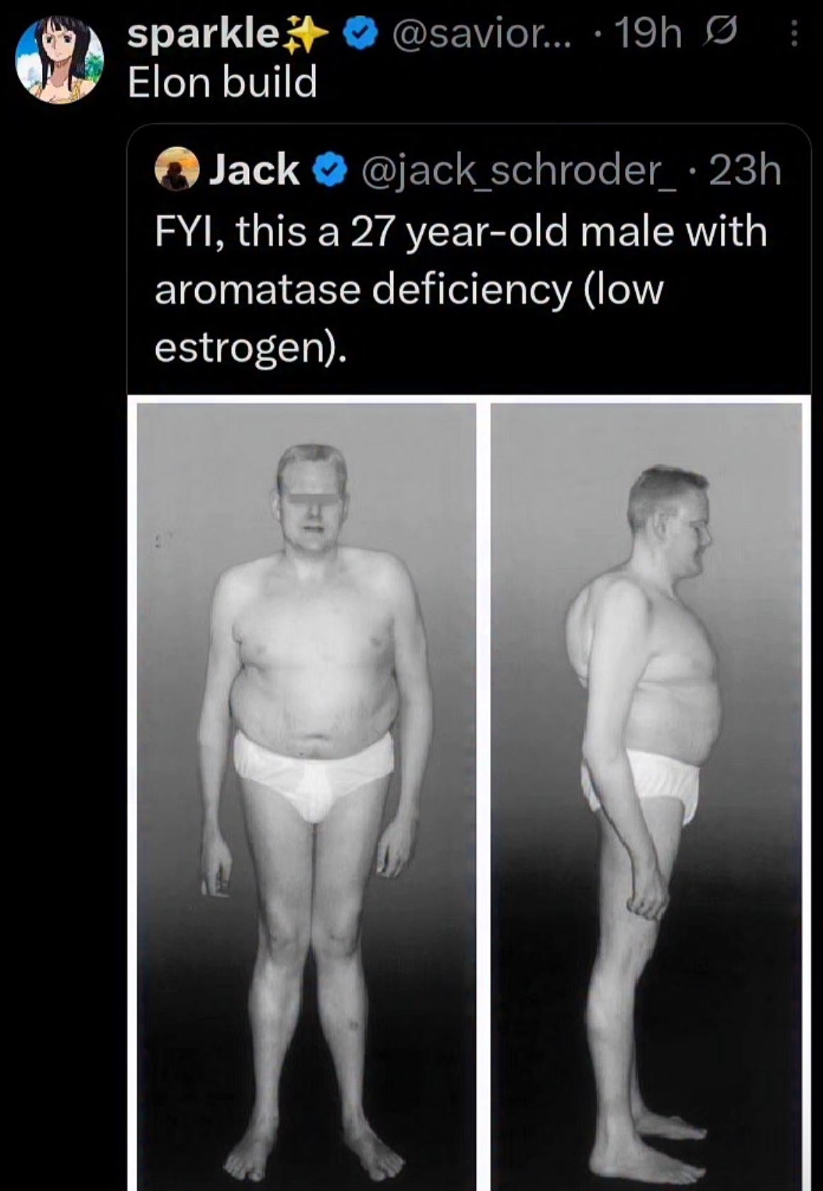 sparkle+ Elon build Jack @savior... 19h • @jack_schroder_ • 23h FYI, this a 27 year-old male with aromatase deficiency (low estrogen).
